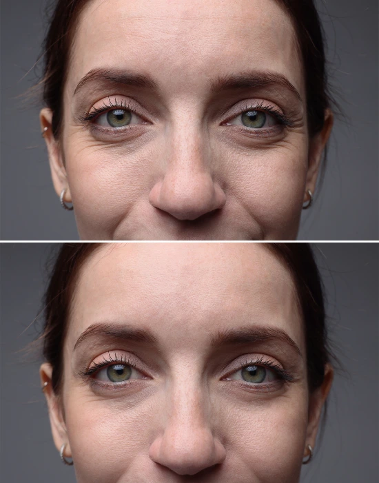 lice pre i posle korišćenja seruma, rezultati seruma